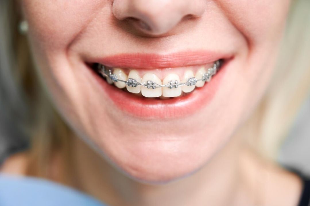 metal ceramic or lingual braces which fits your smile best